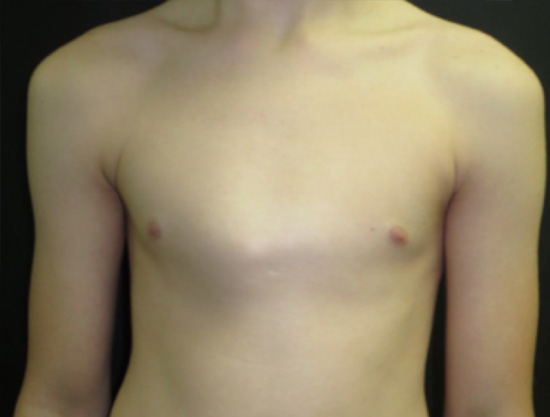 Pectus carinatum in a 14 year old boy. It developed during a rapid growth spurt over a year