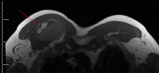 MRI image of a right swollen pectoralis muscle