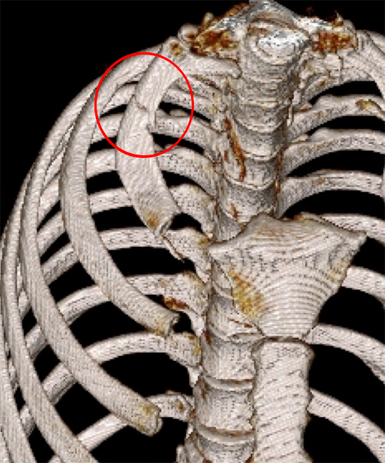 Stress fracture of right first rib (red ring) in a body builder