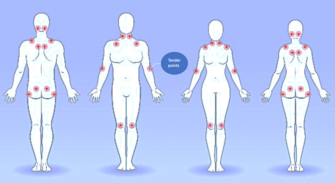Fibromyalgia and the associated paired tender points