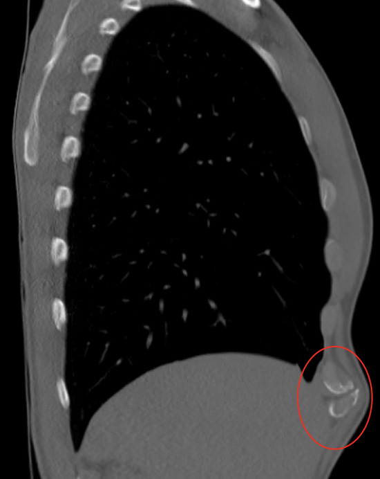 X-ray showing costal arch fracture from side