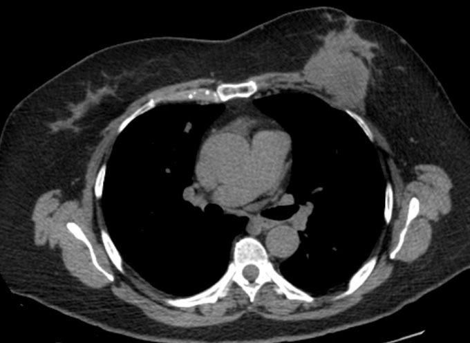 Example of patient with chest wall asymmetry. (A) Patient's