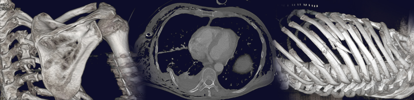 Rib Injury Xrays