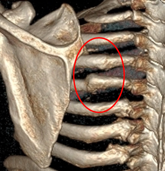 Chest CT reconstruction