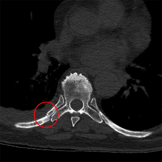 Chest CT following trauma showing rib fracture at neck of rib