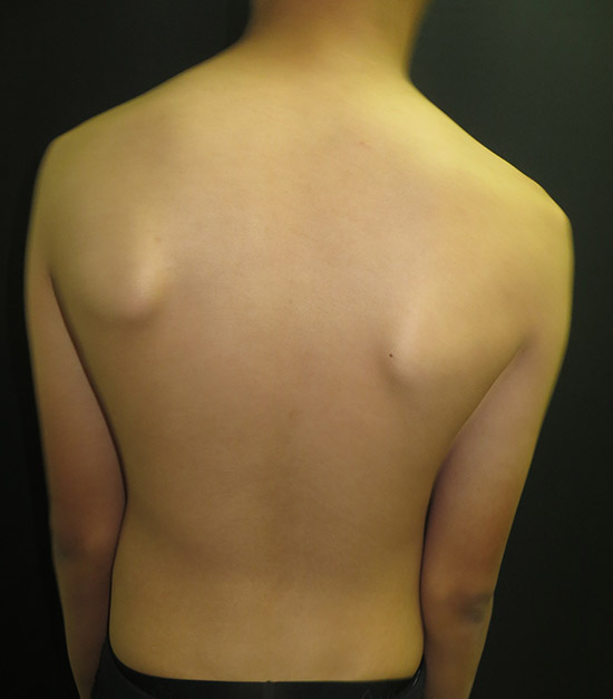 Postural asymmetry of scapula