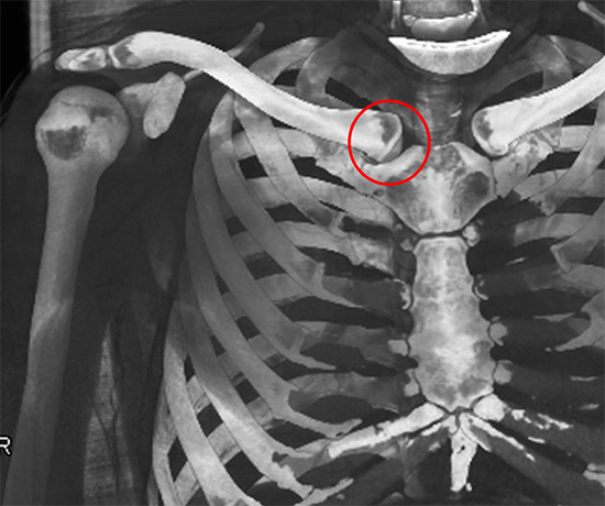 CT reconstruction of sternoclavicular joint