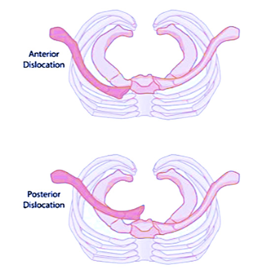 Anterior and posterior dislocation