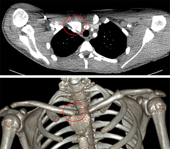 Posterior dislocation