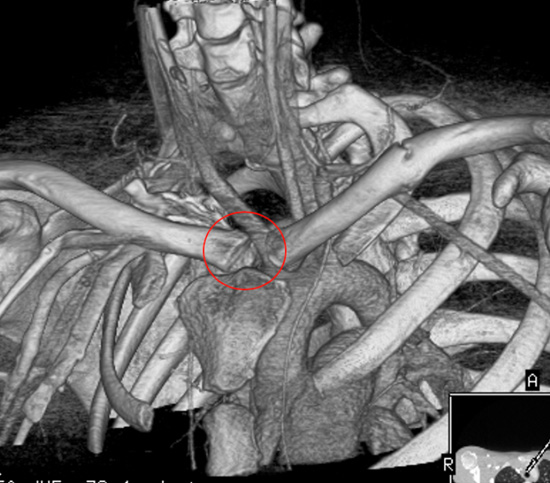 Posterior dislocation