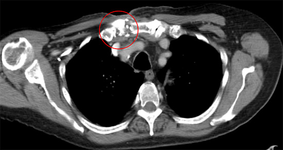 Septic arthritis