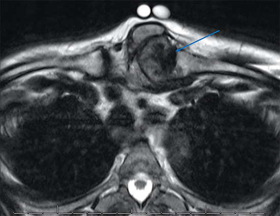 Septic arthritis