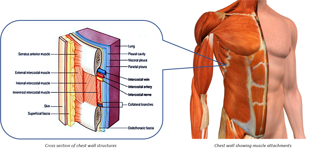 Example of patient with chest wall asymmetry. (A) Patient's