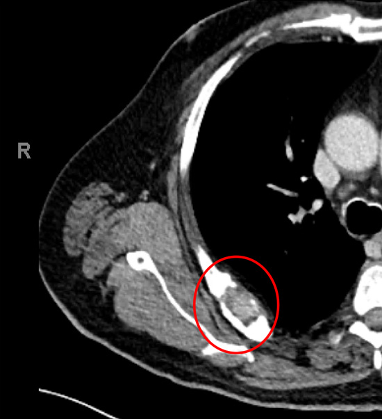 Secondary (metastasis) cancer