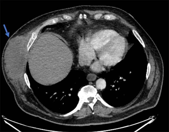 Chest CT scan of a chest wall abscess