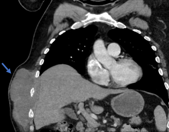 Chest CT scan of a chest wall abscess