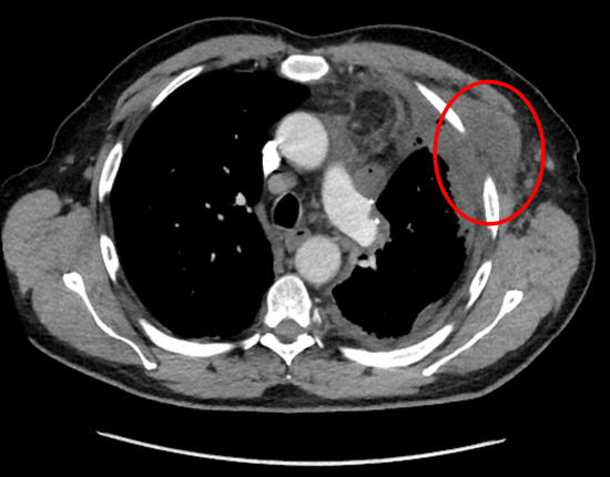 Chest Wall haematoma