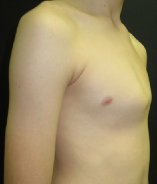 Pectus carinatum in a 14 year old boy. It developed during a rapid growth spurt over a year