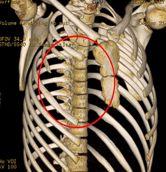 Lump On Chest Near Sternum