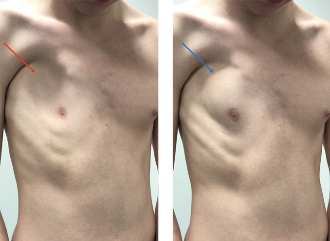 Why Do I Have A Lump On My Left Rib Cage Infoupdate
