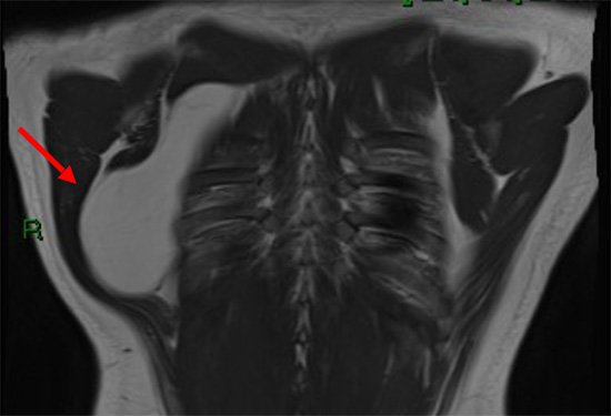 Chest Wall Lumps Rib Injury Clinic