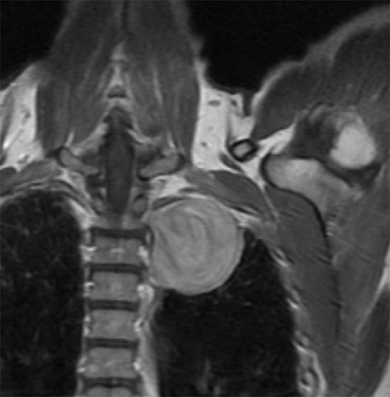 MRI Image of a large Schwannoma