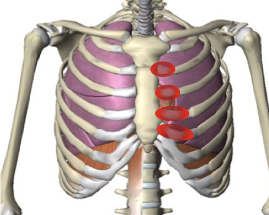 Typical location of pain and tenderness noted in Costochondritis