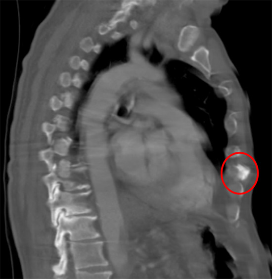 Osteophyte of the sternum