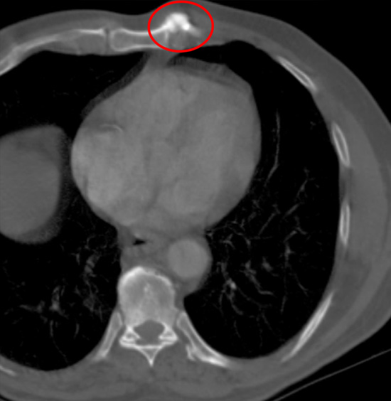 Osteophyte of the sternum