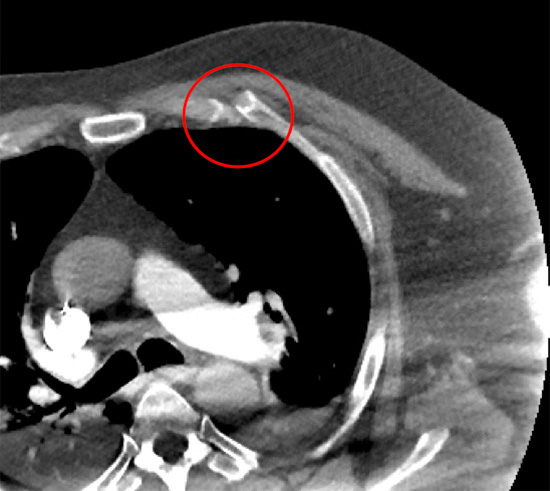 Chest CT scan following fall of an acute costochondral facture