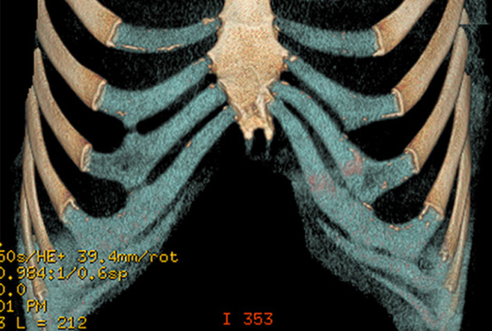 CT reconstruction and rendering of the costal cartilage (in blue) showing the costal arch or margin