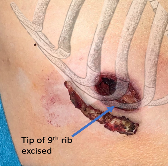 Left costal arch with excision of 9th rib tip