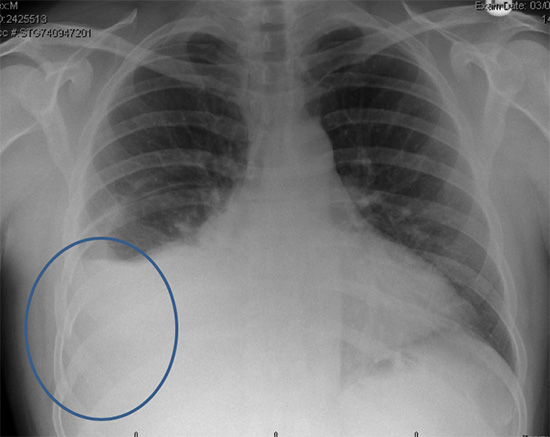 Chest x-ray showing several right-sided broken ribs