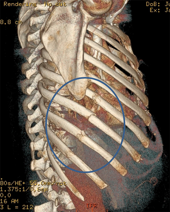 Costosternal and costochondral junctions