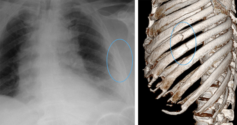 Chest X-ray and CT reconstruction