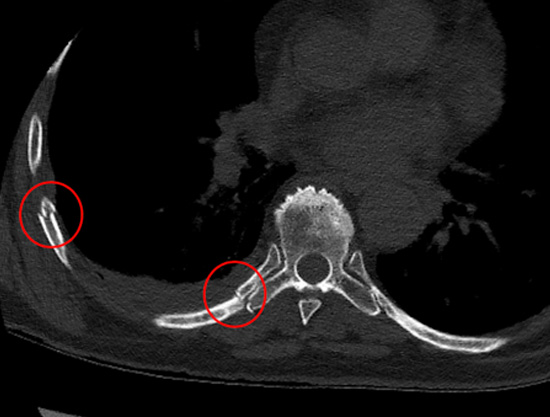 Chest CT demonstrating (in red circles) two non-displaced ‘simple’ rib fractures in different parts of the ribs