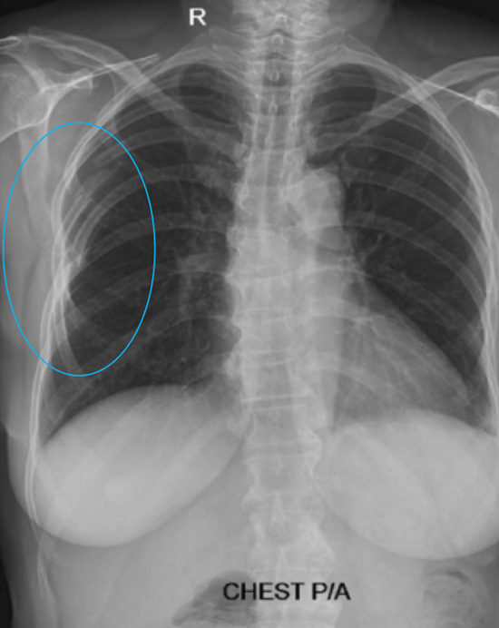 Chest X-ray