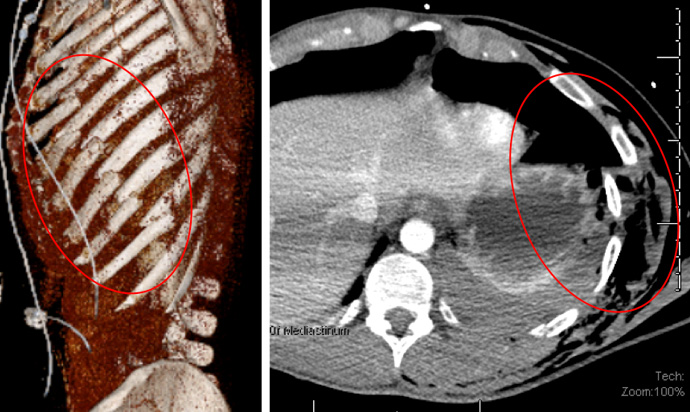 CT chest reconstruction