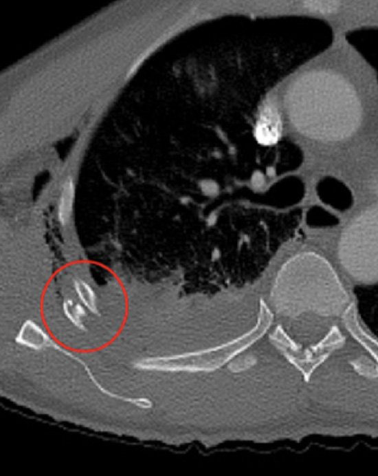 Rib Fracture Ct Scan