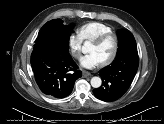 Chest CT scan showing a non-healed rib injury