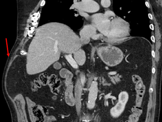 Chest CT scan showing a developing chest wall hernia