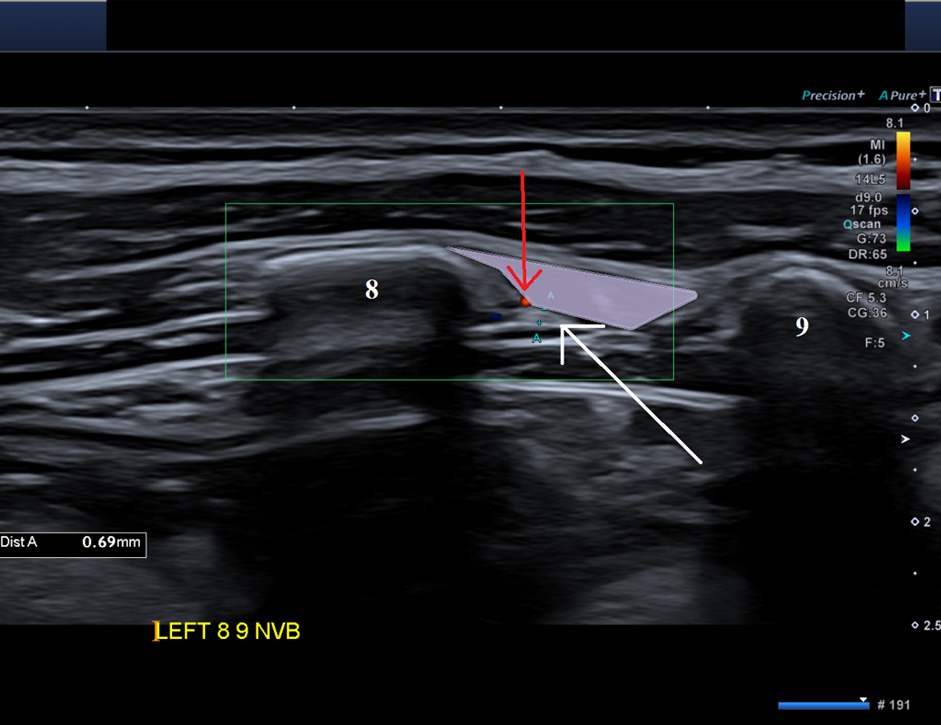 Ultrasound Before