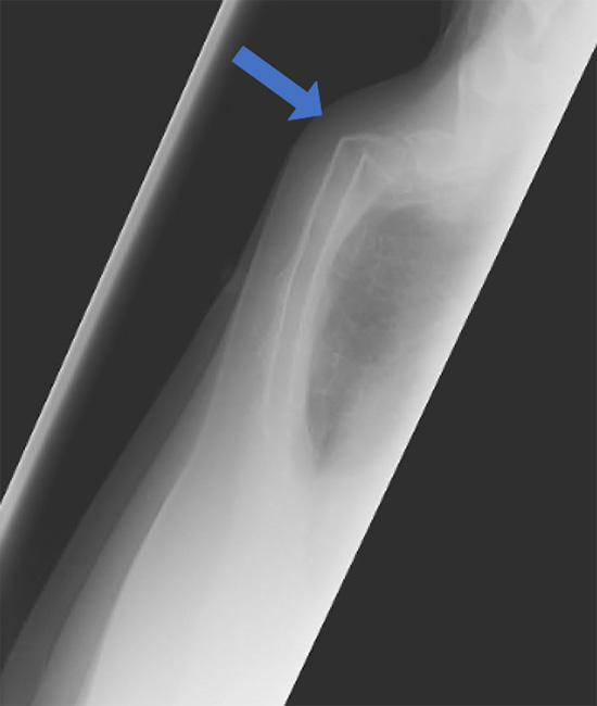 Sternal x-ray from the side showing significant sternal fracture