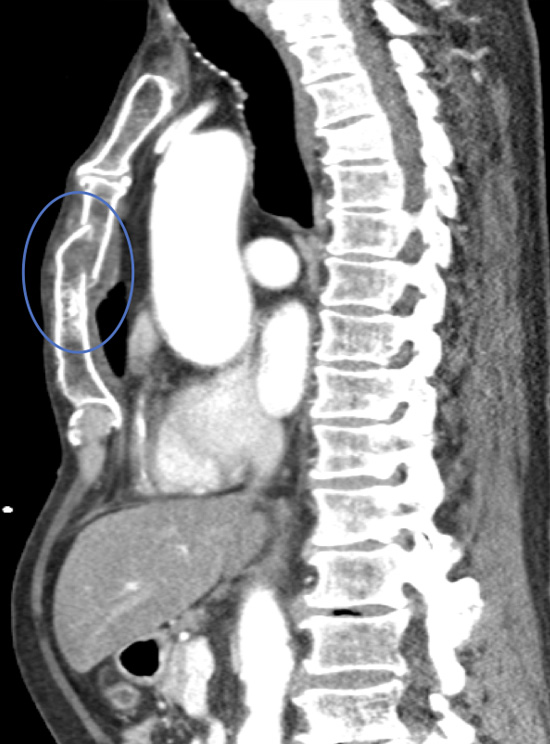 Chest CT scan with 3D reconstruction showing a simple un-displaced fracture of body of sternum