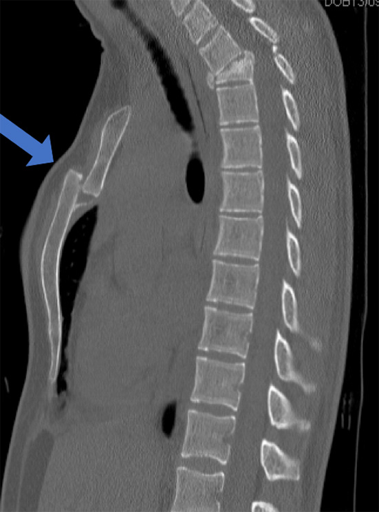 Chest CT showing a displaced sternal fracture