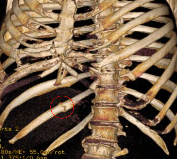 CT reconstruction of sternum and chrondal (cartilage) elements of ribs