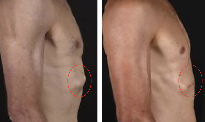 Side view of fracture site before (left) and after (right) open reduction internal fixation
