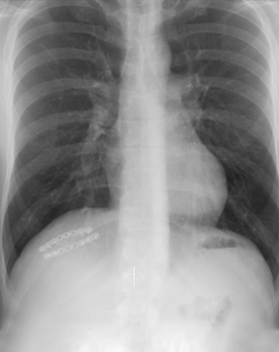 X-ray showing metal plates holding fractured costal arch following internal fixation