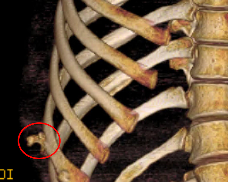 Bone growth around a previous nondisplaced rib fracture