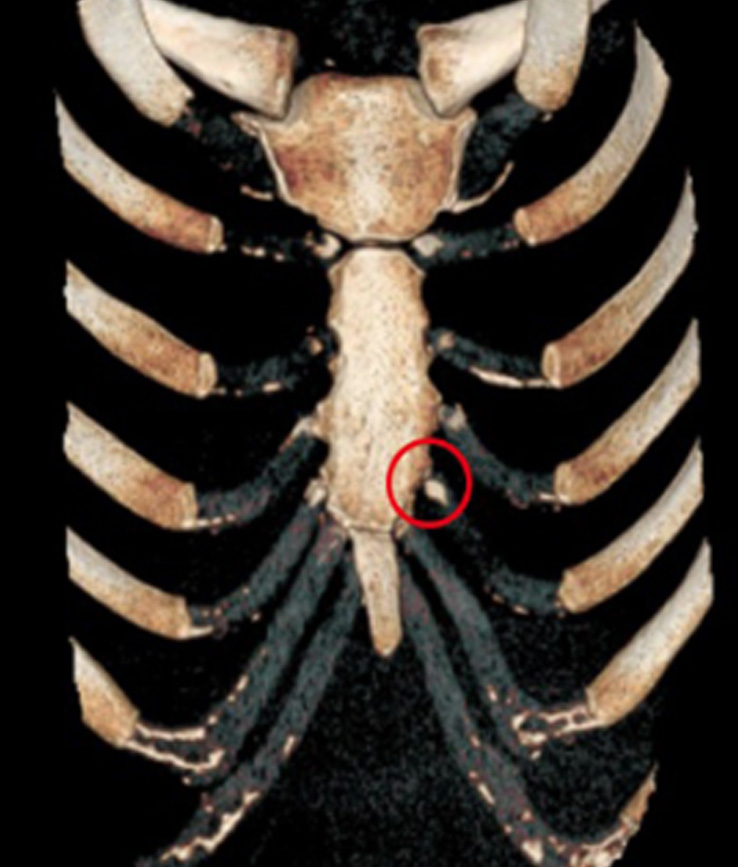 Excision of 5th Sternocostal joint resolved persistent pain and tenderness